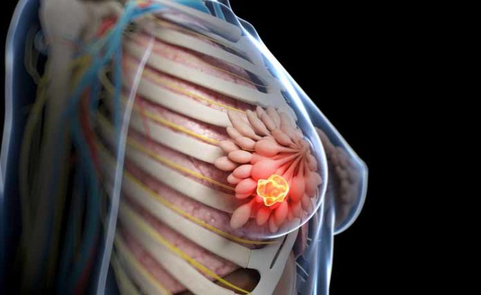 Tumore al seno metastatico, le nuove terapie a bersaglio molecolare meglio della chemio.